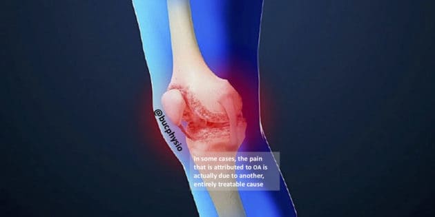 The Surprising Truth About Osteoarthritis